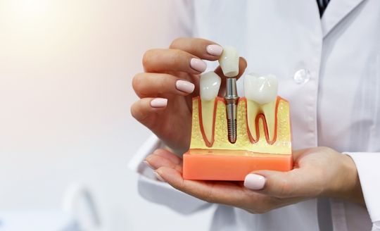 dental-implant-sunnynook-dentist-auckland