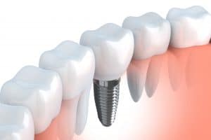 northshore auckland affordable dental implant