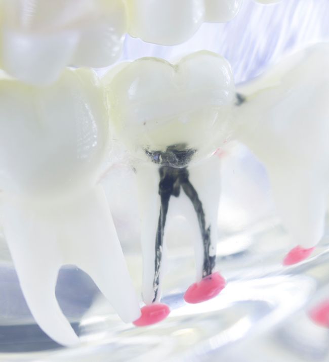 root-canal-treatment-sunny-nook-dentist-north-shore-auckland